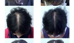 دور أوميغا 3 في تقليل تساقط الشعر