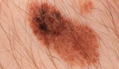 5 علامات قد تدل على سرطان الجلد